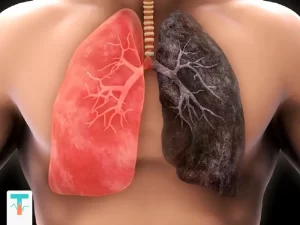 ریه‌ها که نصفی بیمار و نصف دیگر آن سالم است که بخش سالم آن نشانه فواید ترک سیگار است|طب لاین شاپ