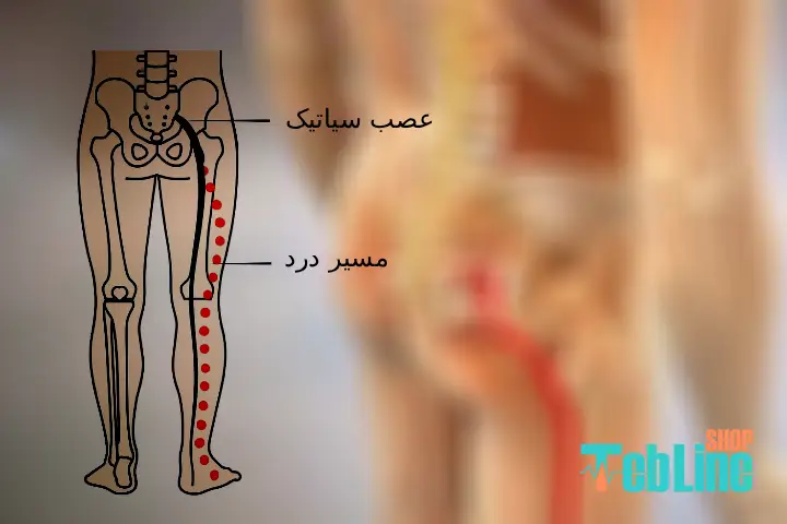 مسیر درد عصب سیاتیک