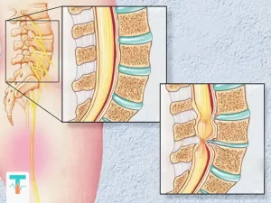درمان خانگی تنگی کانال نخاعی