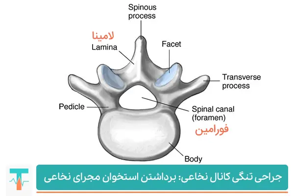 انواع جراحی تنگی کانال نخاعی