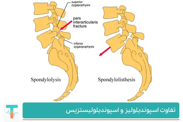 دیسک کمر مهره 4 و 5 تفاوت اسپوندیلولیز و اسپوندیلولیستزیس