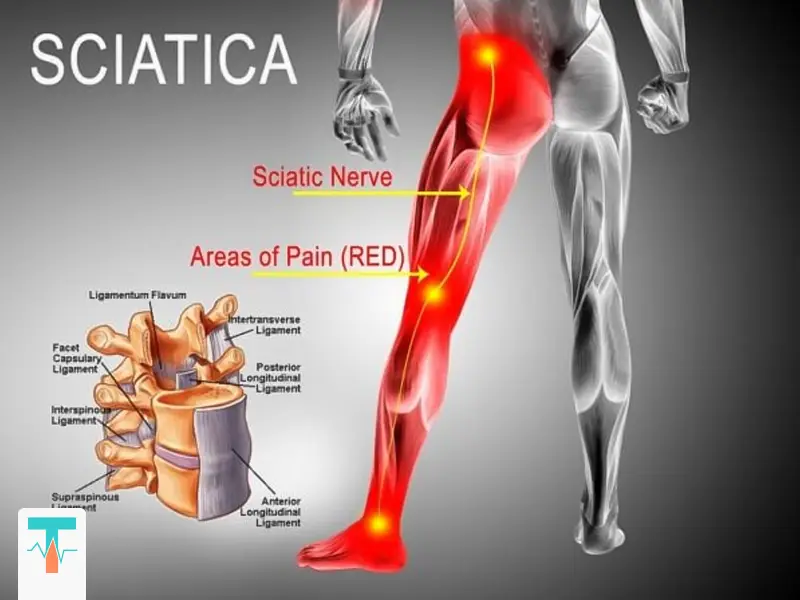 درمان سیاتیک پای چپ
