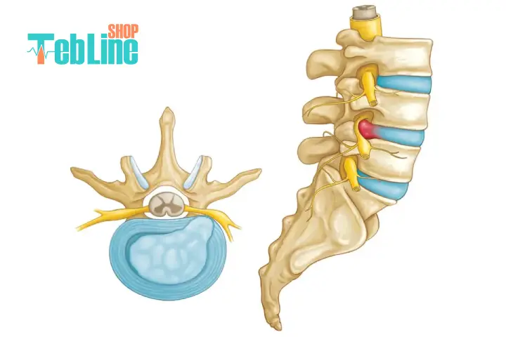 دیسک کمر چیست