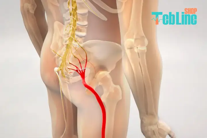 سیاتیک چیست
