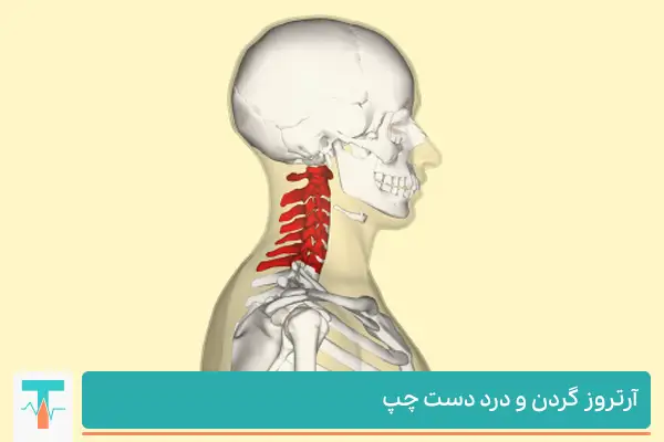 آرتروز گردن و درد در دست به دلیل تحریک عصب های نخاعی