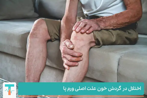 اختلال در گردش خون یکی از علت های اصلی ورم پا