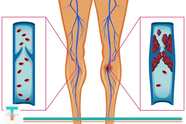 لخته خون در پا یکی از عوامل ایجاد ورم پا است.