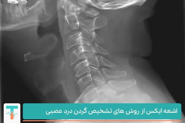 عکس MRI فرد مبتلا به گردن درد عصبی