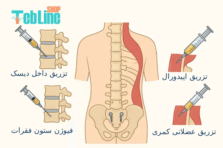 نحوه تزریق پی آر پی کمر