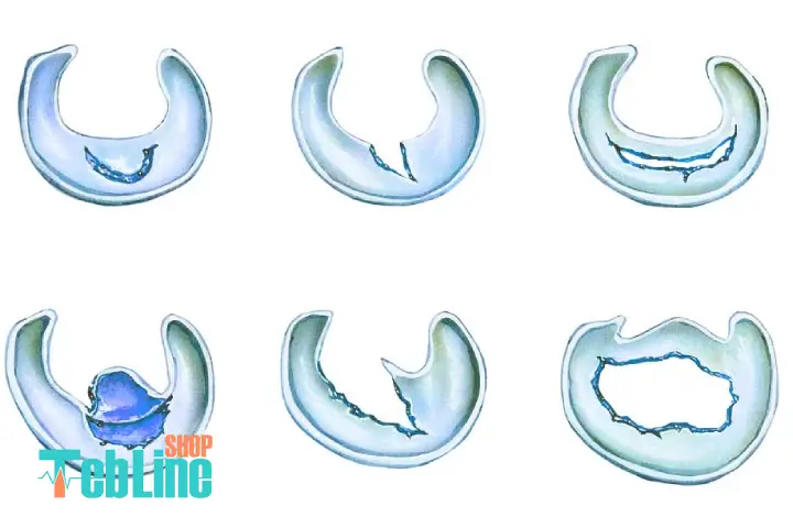 انواع پارگی مینیسک