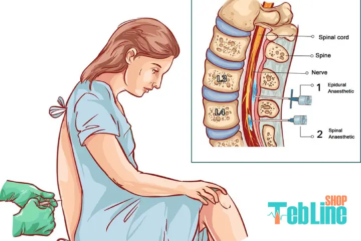 تزریق در فضای اپیدرال