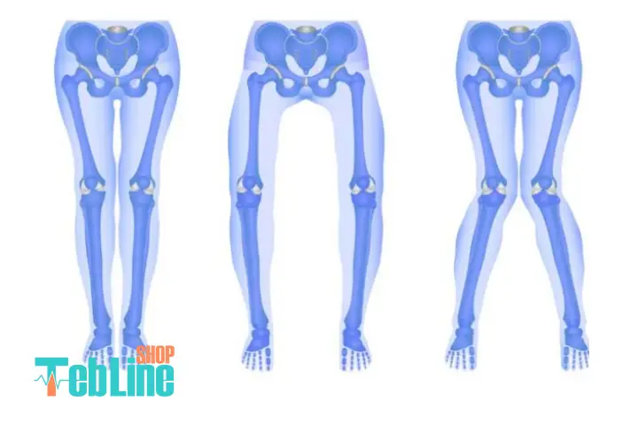 دلایل جراحی استئوتومی زانو