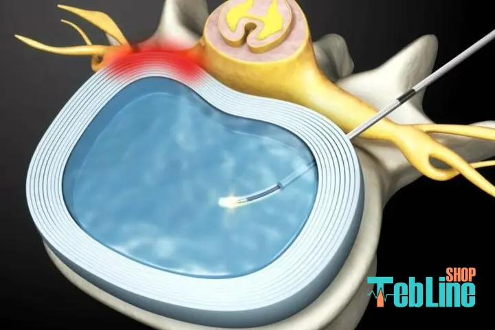 دیسکوژل برای تنگی کانال نخاعی