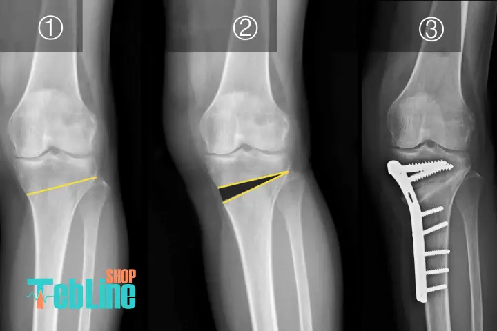 مراحل جراحی استئوتومی زانو