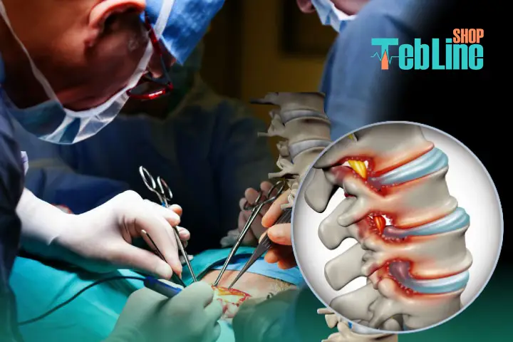 خطرات عمل تنگی کانال نخاعی