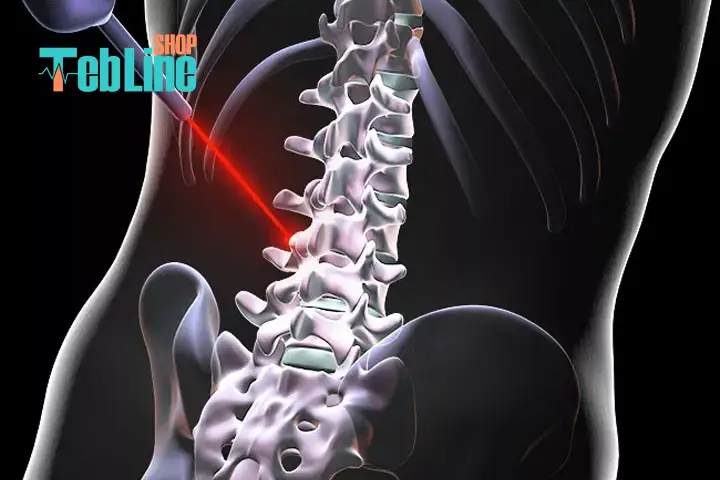 لیزر درمانی تنگی کانال نخاعی