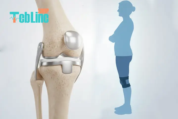 جراحی آرتروز زانو طب لاین